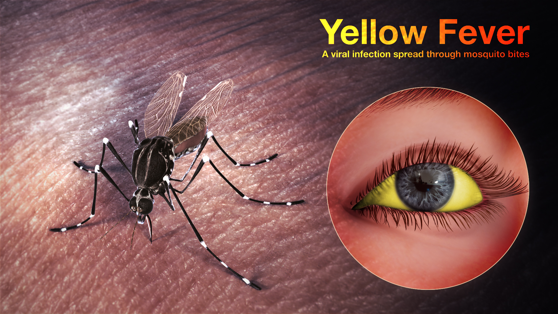 Treatment for Yellow Fever